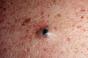 How to get rid of blackheads on the face: pharmacy and folk remedies, salon procedures